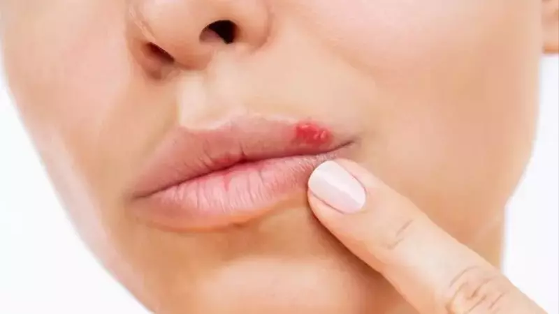 Herpes labial: Cómo combatir los síntomas desde su inicio