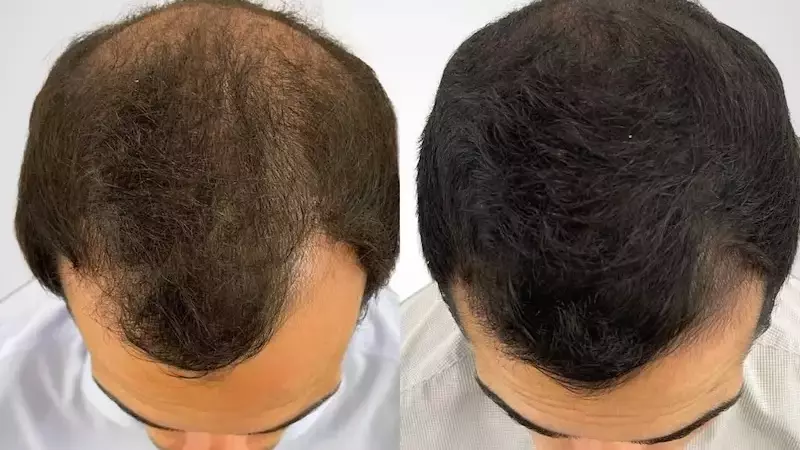 Mesoterapia con Dutasterida: Una Nueva Perspectiva en el Tratamiento de la Alopecia Androgenética